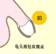包皮包茎