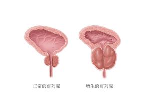 前列腺肥大